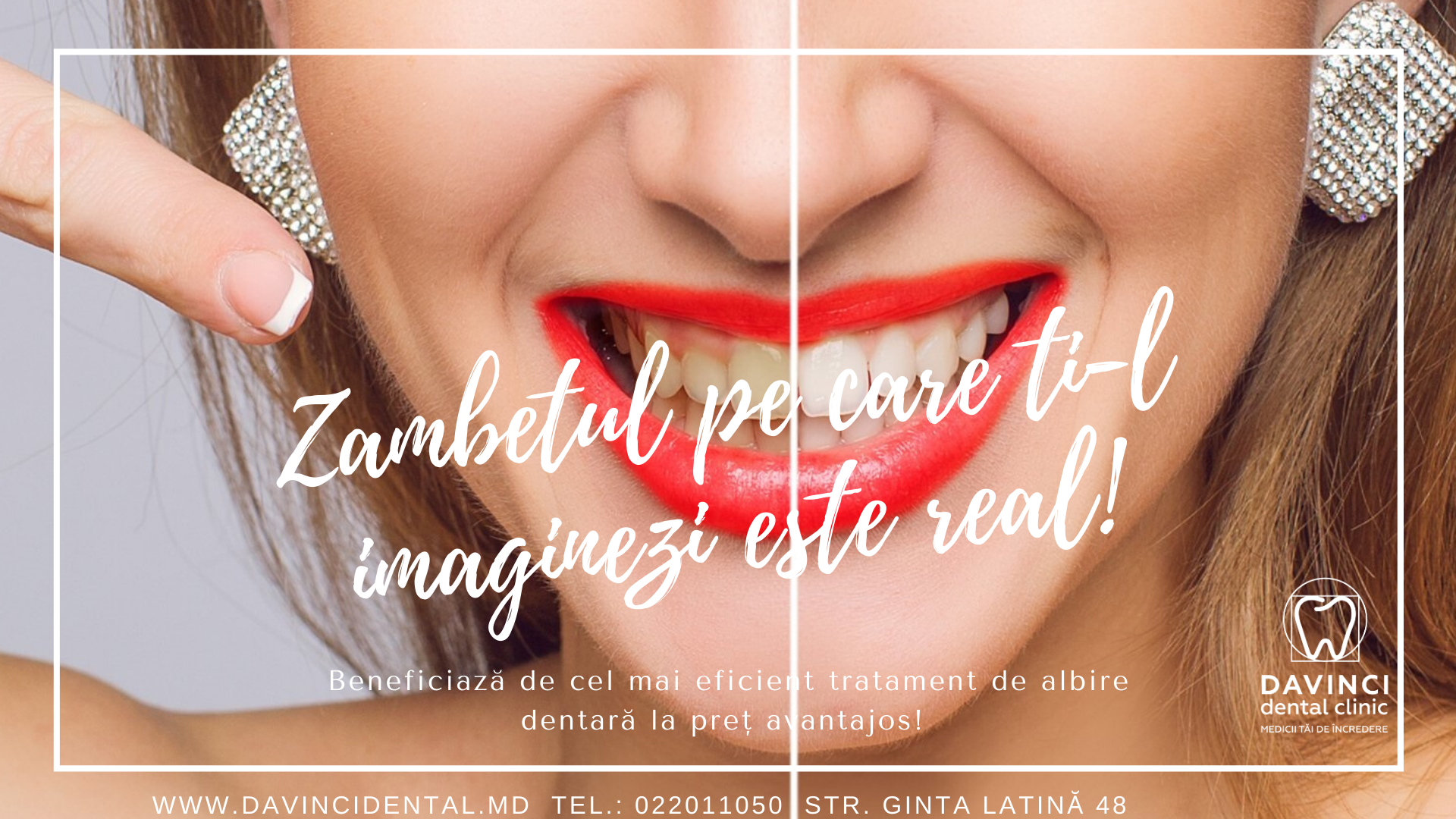 FAQ albire dentara davinci dental clinic